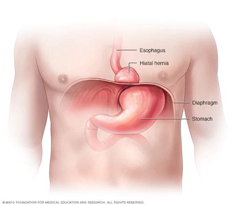 Hiatal Hernia Symptoms And Causes Mayo Clinic Hernia De Hiato