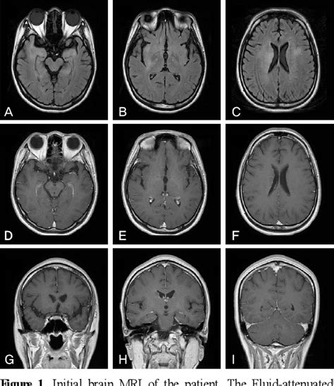 Figure 1 From Anti Nmda Receptor Encephalitis Which Has Shown Clinical Symptoms Of Schizophrenia