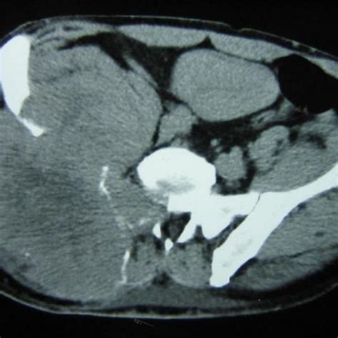 Hydatid Cyst Axial Pelvic T2w Mri Showing A Lobulated And Septated