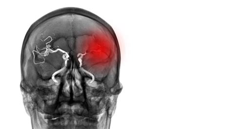 Penanganan Awal Pada Stroke Iskemik Akut Alomedika