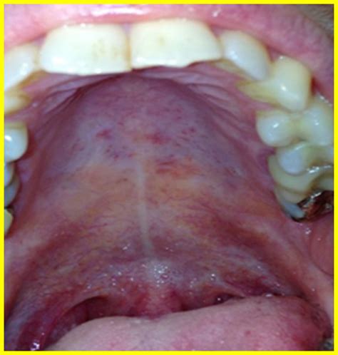 Oral And Cutaneous Manifestations Of Viral And Bacterial Infections