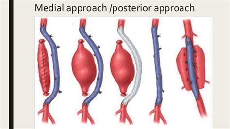 Popliteal artery aneurysm