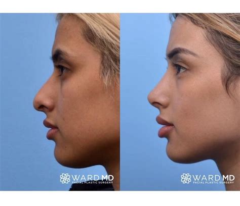 Ward MD Rhinoplasty Before After This Patient Wanted To Correct Her