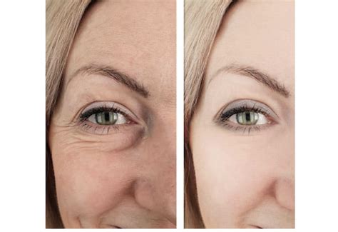 Under Eye Filler Before And After Under Eye Filler Near Me Eye Filler Toronto