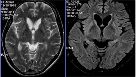 Mri Showing Caudate Atrophy And Striatal Hyperintensities In Both T Wi