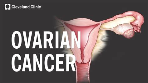 5 Warning Signs And Risk Factors Of Ovarian Cancer Youtube