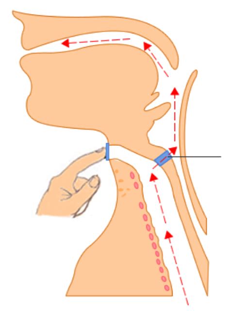 Tracheostomy