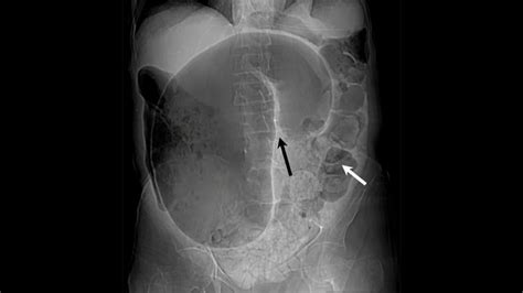 VÓVULO SIGMOIDEO RADIOGRAFÍA DE ABDOMEN YouTube