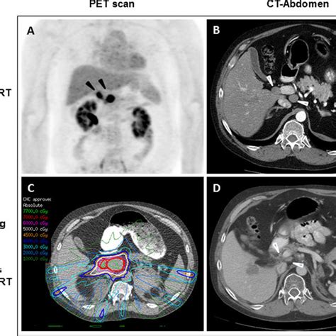 Case Radiologic Findings Of Portacaval Adenopathies Before And After