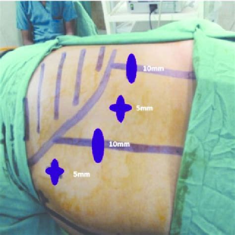 Removal of specimen via 10 mm port. | Download Scientific Diagram