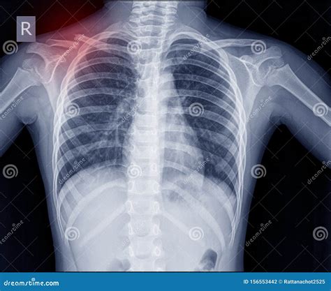 Chest X Ray Fracture Right Clavicle Stock Photo Image Of Broken Hurt