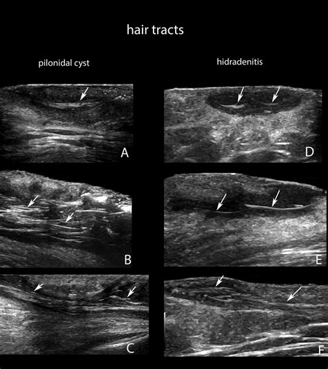 Pilonidal Cyst Mri