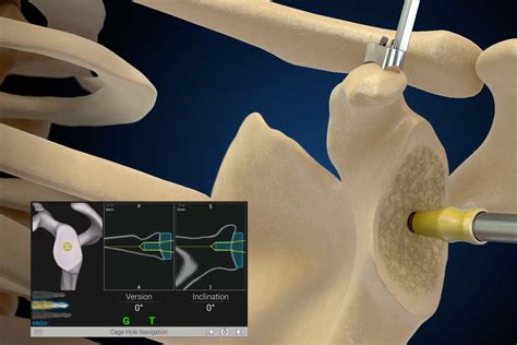 Using Gps To Assess Glenoid Morphology In Reverse Shoulder Arthroplasty