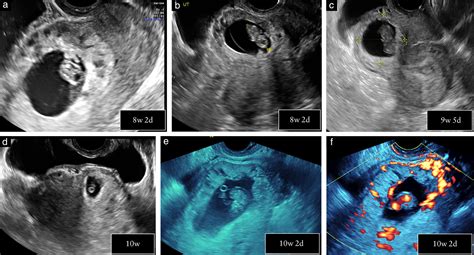 Early First‐trimester Transvaginal Ultrasound Is Indicated In Pregnancy After Previous Cesarean