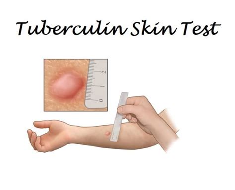 Tuberculin Skin Test Detailed Information