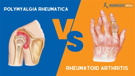 Polymyalgia Rheumatica Vs Rheumatoid Arthritis Key Differences Rheumatologist Oncall