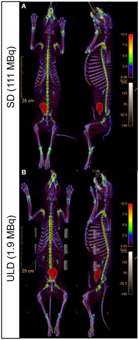 Representative whole body ¹⁸F NaF PET CT uptake fusion showing the