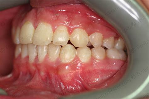 Case 12: Overlapping and “big” front teeth | Teeth N Braces