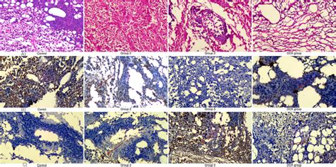 Histopathology And Immunohistochemistry Staining Sections Of Breast