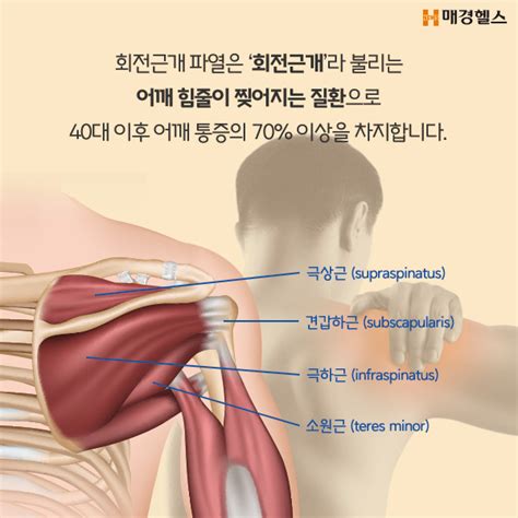 건강스펀지 어깨 회전근개 파열 무조건 수술해야 할까