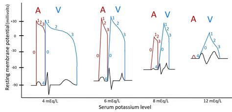 Illustration Of EKG Changes And Superimposed Atrial And Ventricular