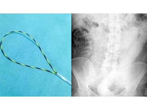 New Tool Was Invented To Remove A Inch Dildo From Mans Rectum Boldsky