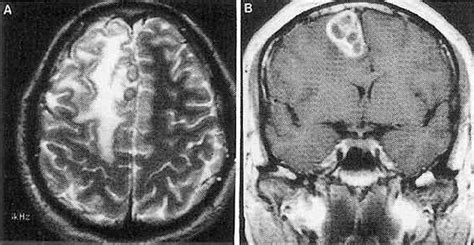 Coccidioidomycosis Brain Abscess In Journal Of Neurosurgery Volume 81 Issue 4 1994