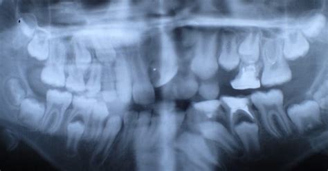 Full Mouth X-ray: Diagnostic Insights