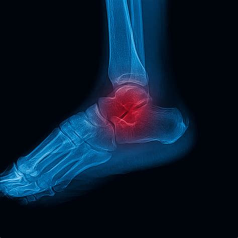 Ankle Fracture - Brighton Foot and Ankle