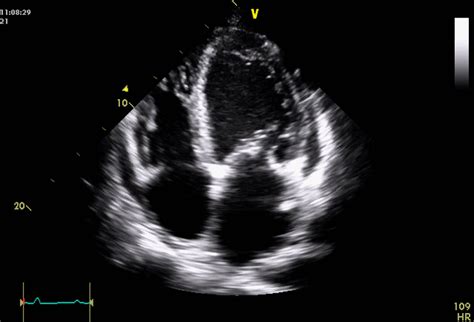 Heart Failure Echocardiogram Gif