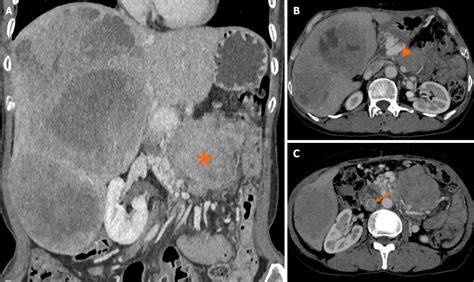 Unraveling The Enigma A Comprehensive Review Of Solid Pseudopapillary