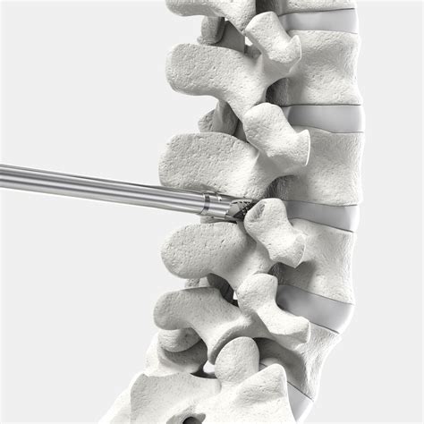 CORUS Spinal System-LX | Providence
