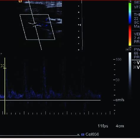 Ultrasound of left ICA at the discharge one week after the procedure. | Download Scientific Diagram