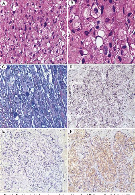 PDF Breast Invasive Lobular Carcinoma A Retrospective