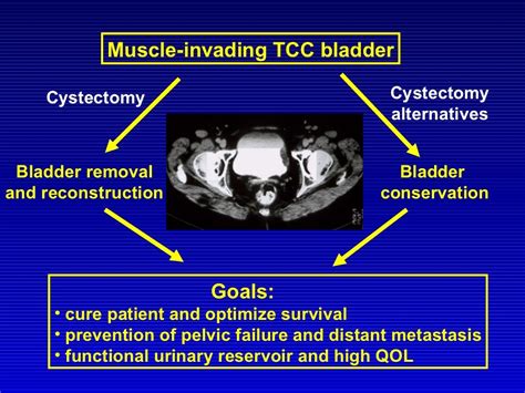 Bladder Sparing Trimodality Therapy For Muscle Invasive Bladder Cancer