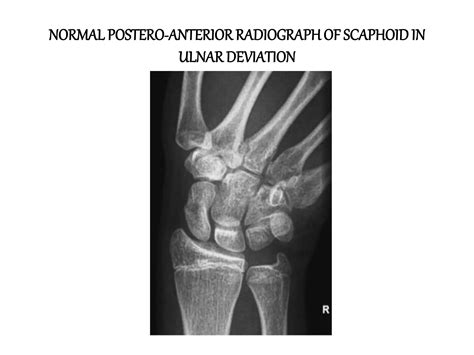 Basic views of scaphoid and wrist | PPT