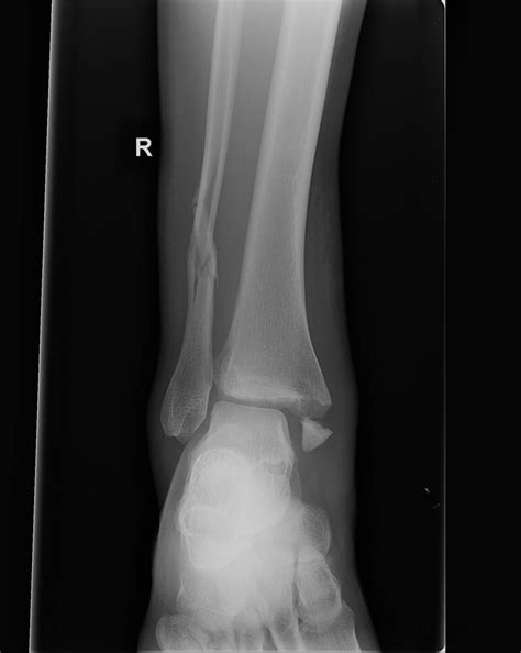 AO/OTA classification of the tibial malleolar fractures - wikidoc