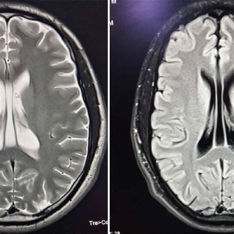 Brain Mri Coronal Plane T Weighted Image Showing The Third Ventricles