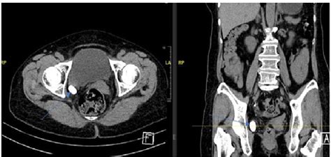 Figure From The Rare Case Of The Migrated Tubal Ligation Clip