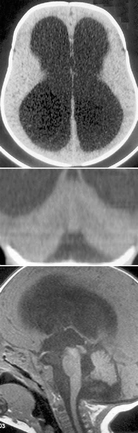 Figure From Intramedullary Capillary Hemangioma Associated With