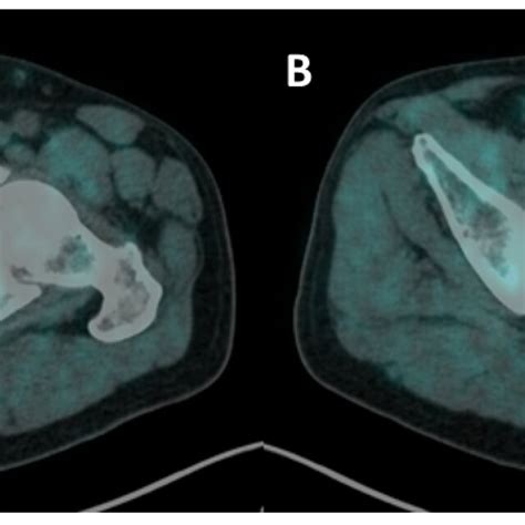 A B transaxial fused images manual workflow of ¹⁸F F choline PET CT