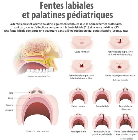 Fente Palatine Causes Sympt Mes Et Traitements