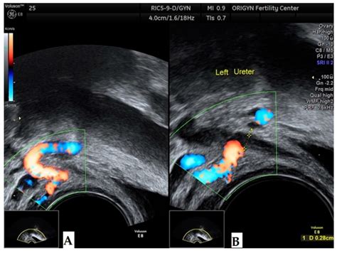 Uterus Ultrasound Transvaginal