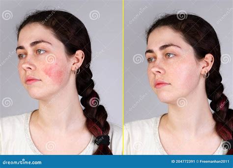 Portrait Of A Young Caucasian Woman With Red And Inflamed Blood Vessels