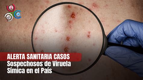 Msp Confirma Hay Casos Sospechosos De Viruela S Smica Cachicha