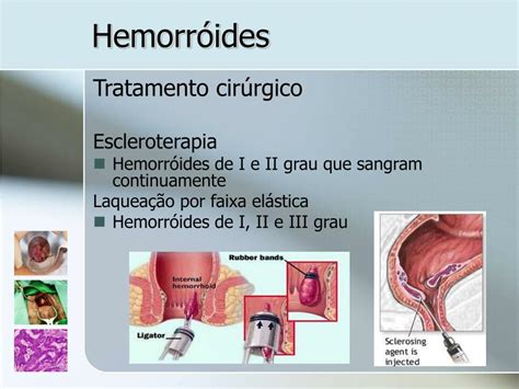 Ppt Patologia Perianal Powerpoint Presentation Free Download Id 829116