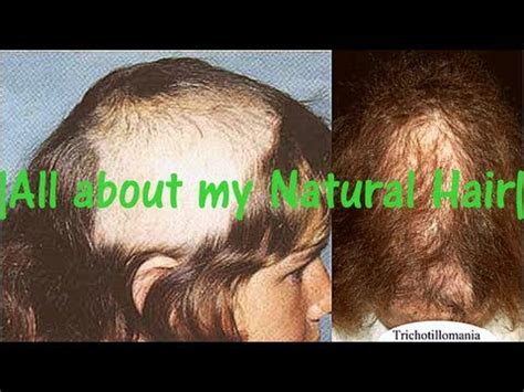 All About My Natural Hair OCD Trichotillomania Why I Cut It Hair