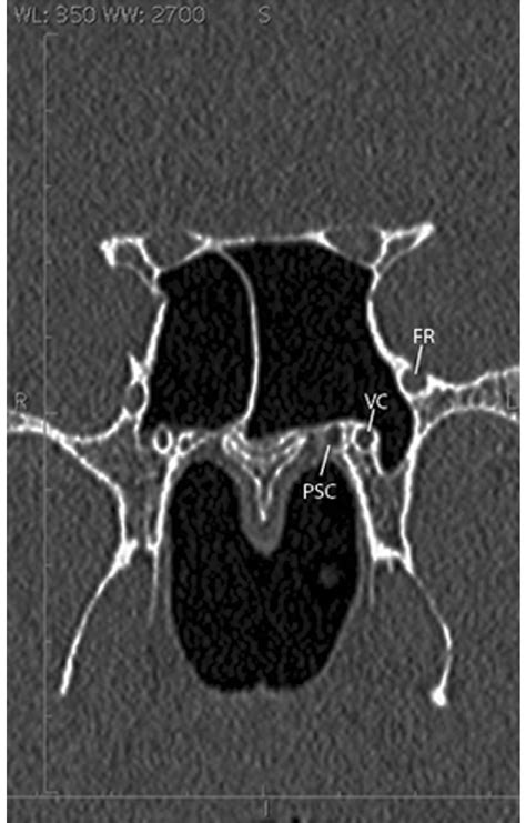 Foramen Rotundum Ct Coronal