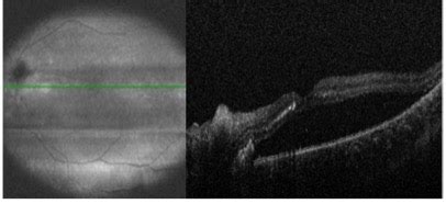 Moran CORE Fundus Photography Fluorescein Angiography And Optical