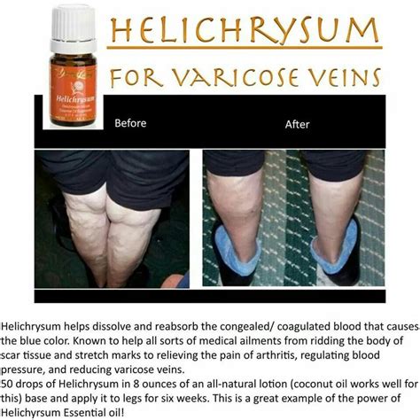 Essential Oils For Varicose Veins Health And Fitness Pinterest